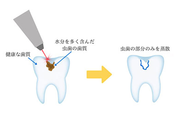むし歯治療の例