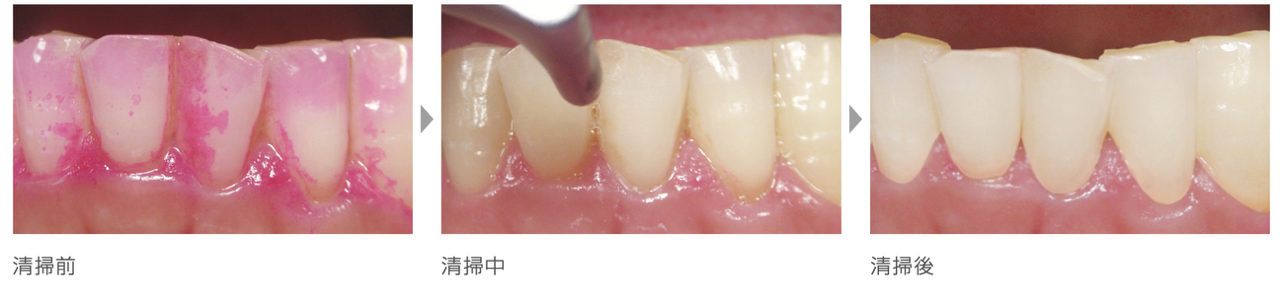 エアフロー処置